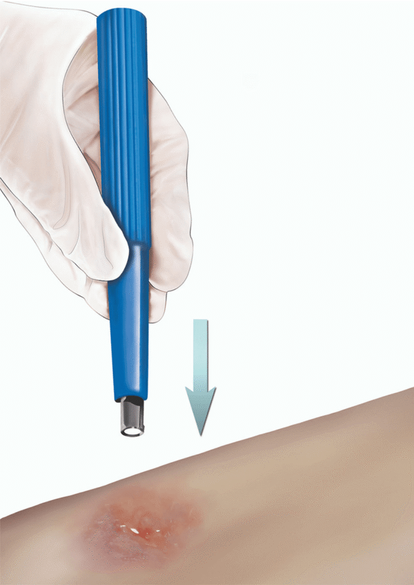 Skin Biopsy